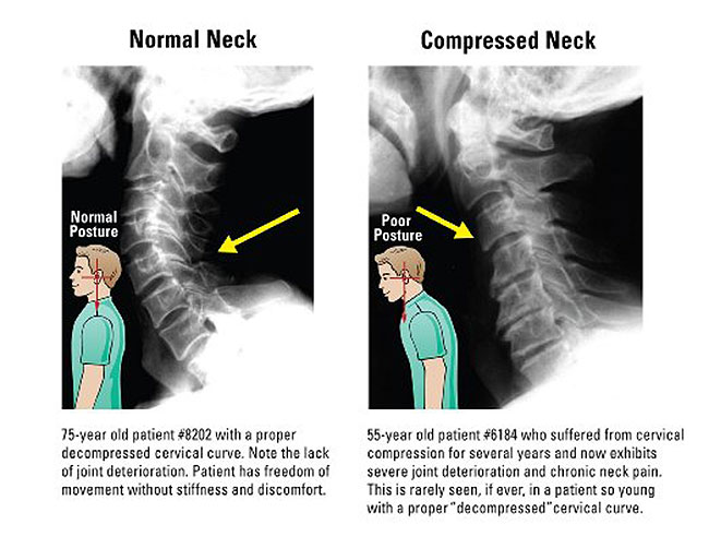 posture-pump-1400D-x-ray-results