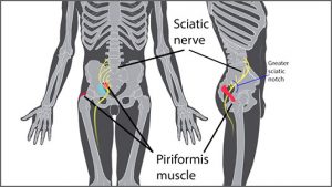 sciatica-piriformis-syndrome-brighter-536x302